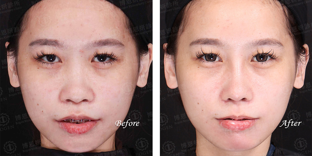 韓式隆鼻,結構式隆鼻,FITME完形美,博恩妍